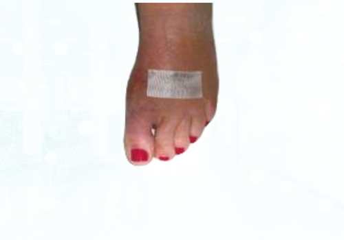 before after foot deformaties10a