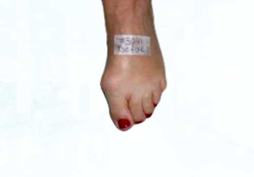 before after foot deformaties10b