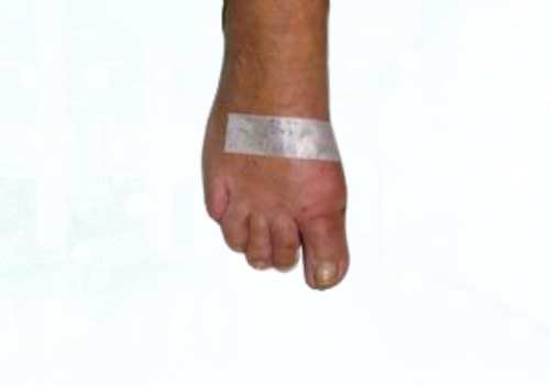 before after foot deformaties11a