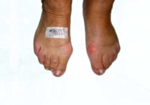before after foot deformaties11b