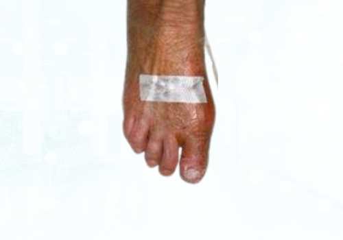 before after foot deformaties12a