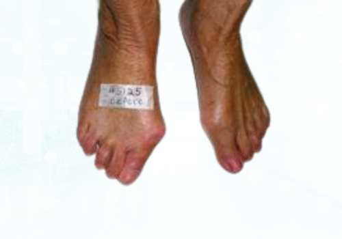 before after foot deformaties12b