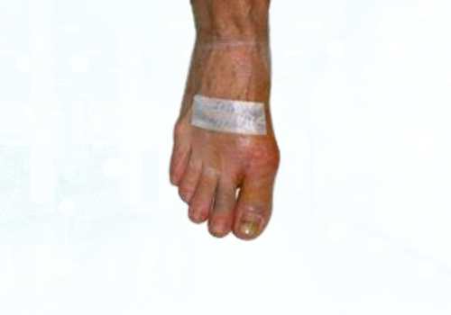 before after foot deformaties13a