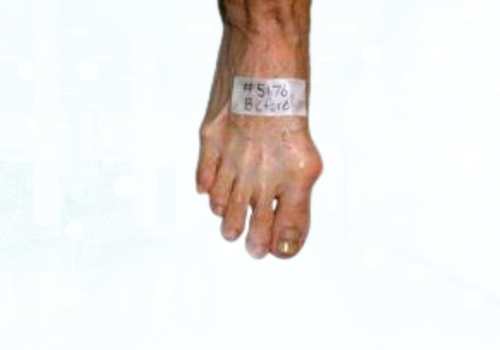 before after foot deformaties13b