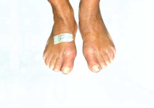 before after foot deformaties14a