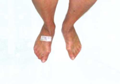 before after foot deformaties14b