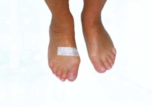 before after foot deformaties15a