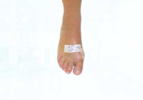 before after foot deformaties15b