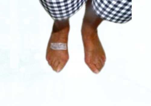 before after foot deformaties16a
