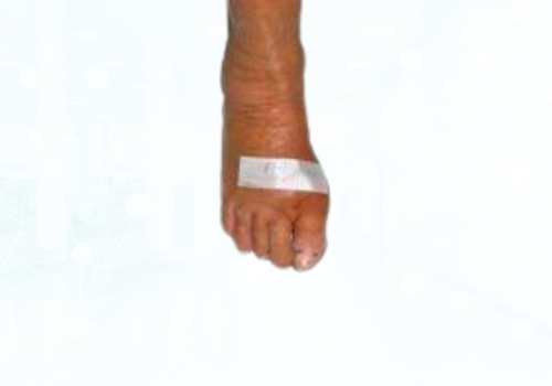 before after foot deformaties16b