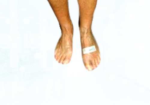 before after foot deformaties17a