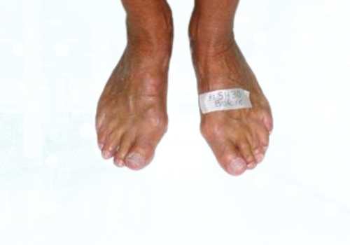 before after foot deformaties17b