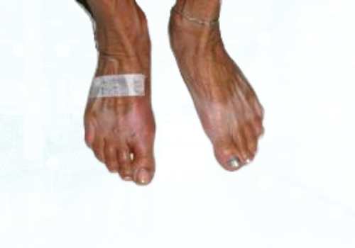 before after foot deformaties18a