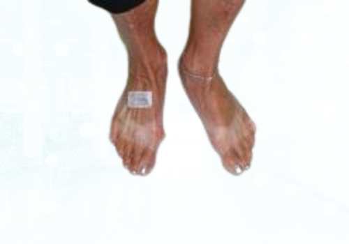 before after foot deformaties18b