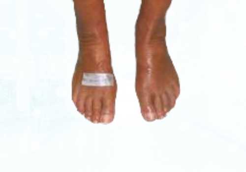 before after foot deformaties19a