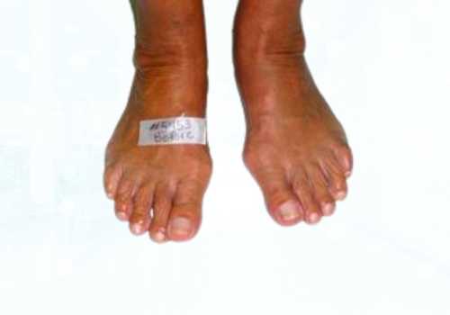before after foot deformaties19b