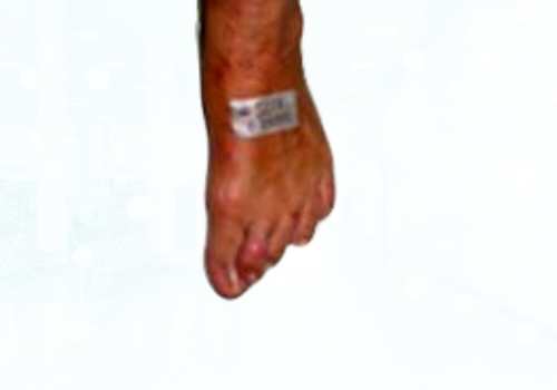 before after foot deformaties1a