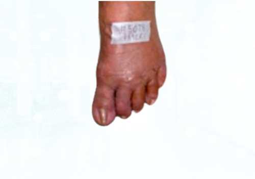 before after foot deformaties1b