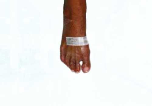 before after foot deformaties20a