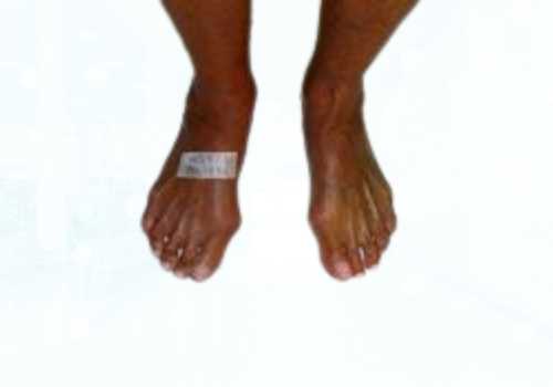 before after foot deformaties20b