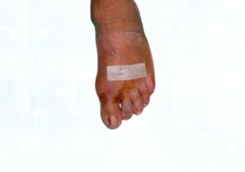 before after foot deformaties21a
