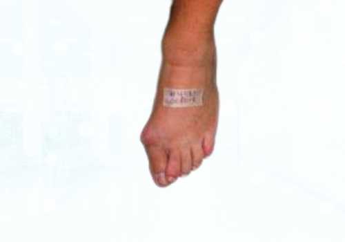 before after foot deformaties21b