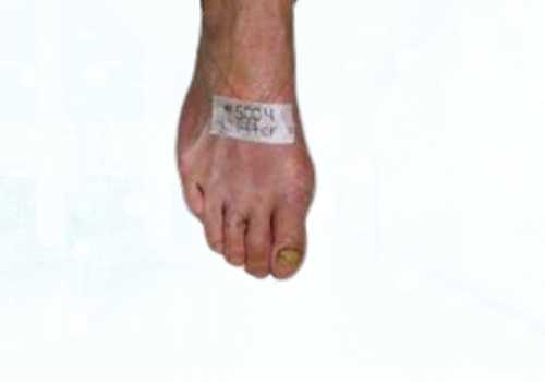 before after foot deformaties22a