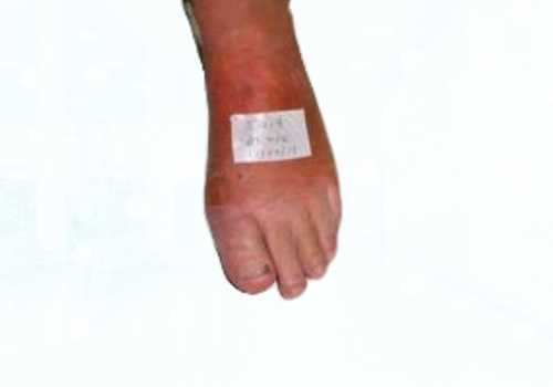 before after foot deformaties23a