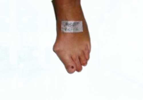 before after foot deformaties23b