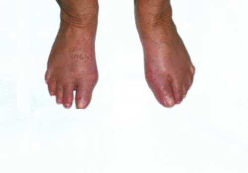 before after foot deformaties24a