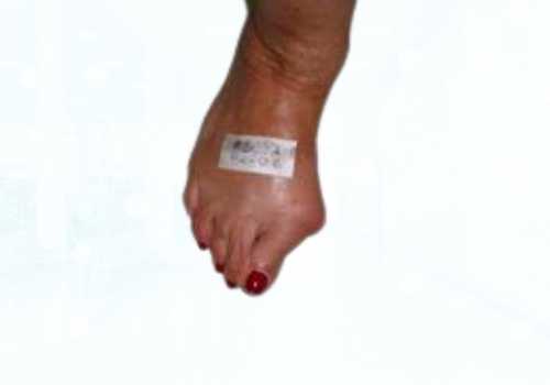 before after foot deformaties24b