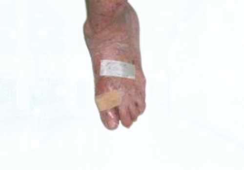 before after foot deformaties25a