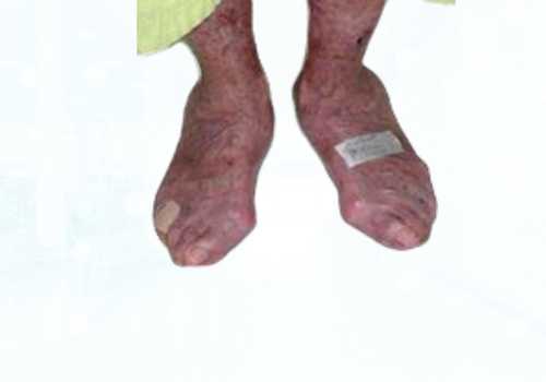 before after foot deformaties25b