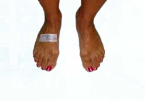 before after foot deformaties26a