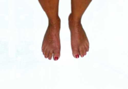 before after foot deformaties26b