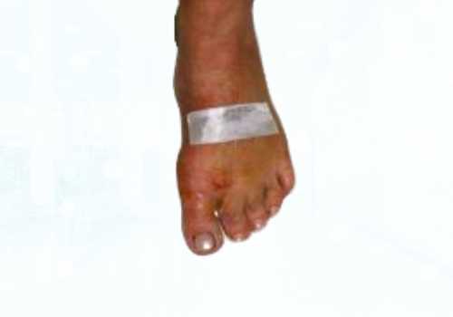before after foot deformaties27a