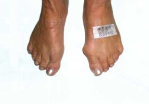 before after foot deformaties27b