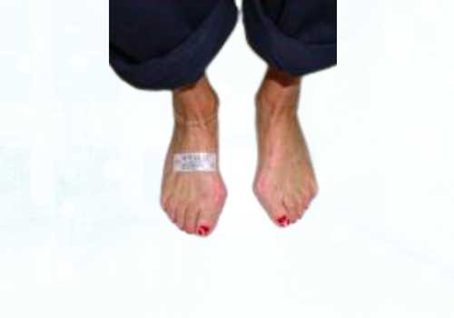 before after foot deformaties28b
