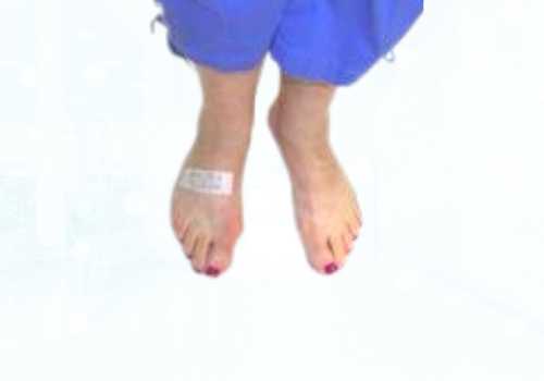 before after foot deformaties29a