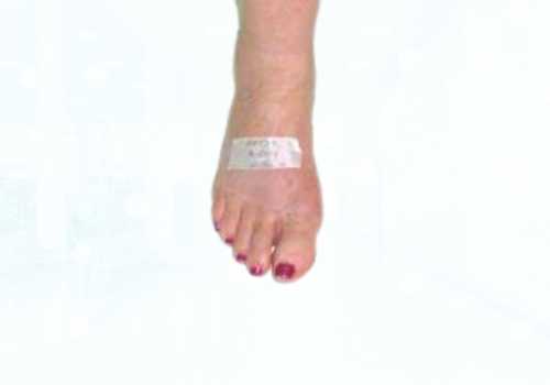 before after foot deformaties29b