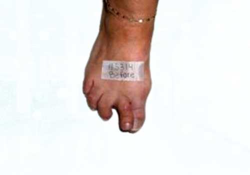 before after foot deformaties2a