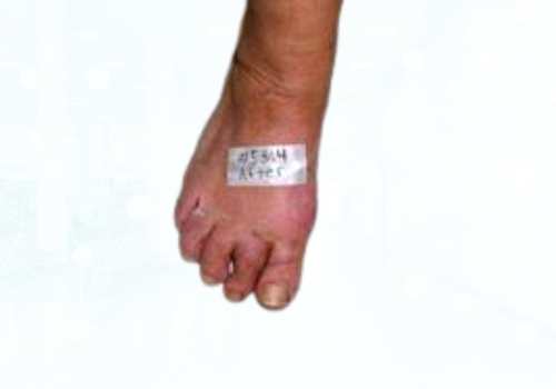 before after foot deformaties2b