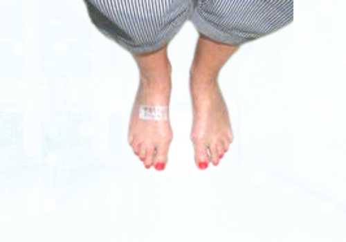 before after foot deformaties30a