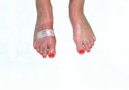 before after foot deformaties30b