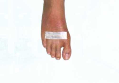 before after foot deformaties31a