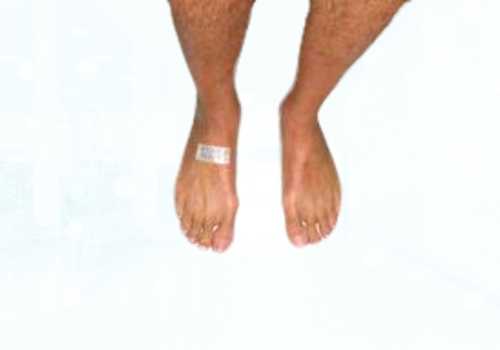 before after foot deformaties31b