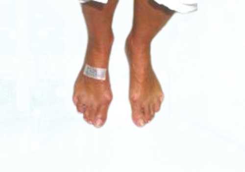 before after foot deformaties32a