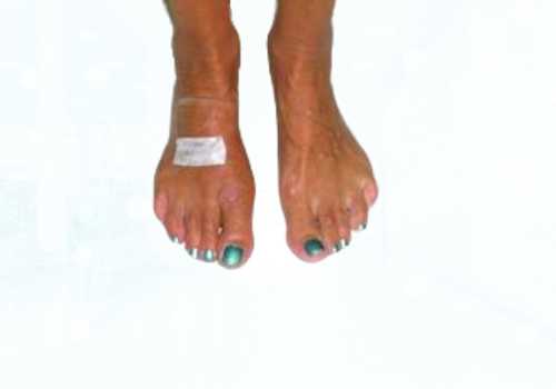 before after foot deformaties32b