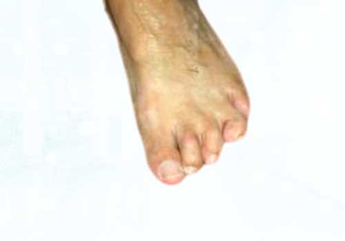 before after foot deformaties3a