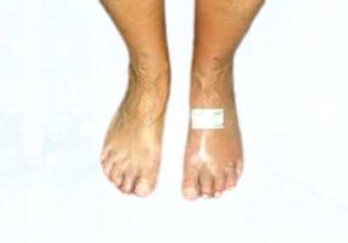 before after foot deformaties3b